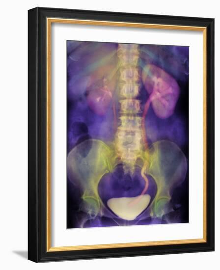 Kidney Stone In Ureter-Science Photo Library-Framed Photographic Print