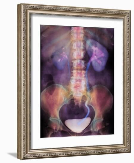 Kidney Stone In Ureter-Science Photo Library-Framed Photographic Print