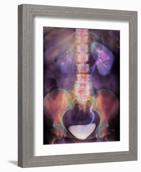 Kidney Stone In Ureter-Science Photo Library-Framed Photographic Print