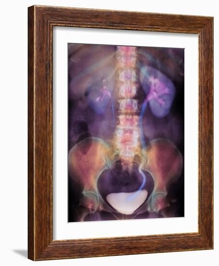 Kidney Stone In Ureter-Science Photo Library-Framed Photographic Print