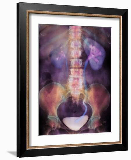 Kidney Stone In Ureter-Science Photo Library-Framed Photographic Print