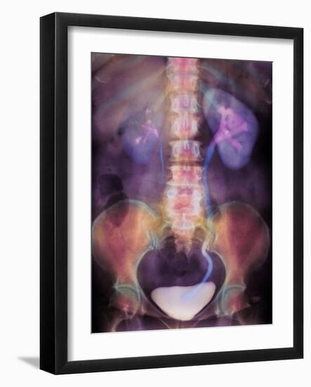 Kidney Stone In Ureter-Science Photo Library-Framed Photographic Print