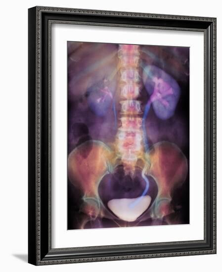 Kidney Stone In Ureter-Science Photo Library-Framed Photographic Print