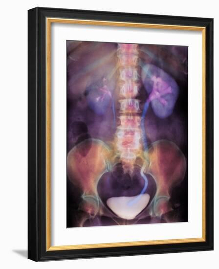 Kidney Stone In Ureter-Science Photo Library-Framed Photographic Print