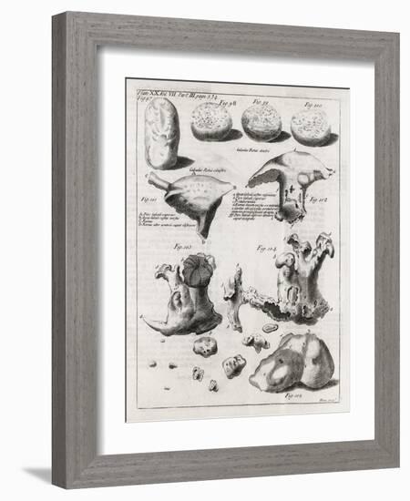 Kidney Stones, 18th Century-Middle Temple Library-Framed Photographic Print