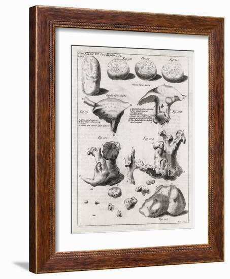 Kidney Stones, 18th Century-Middle Temple Library-Framed Photographic Print