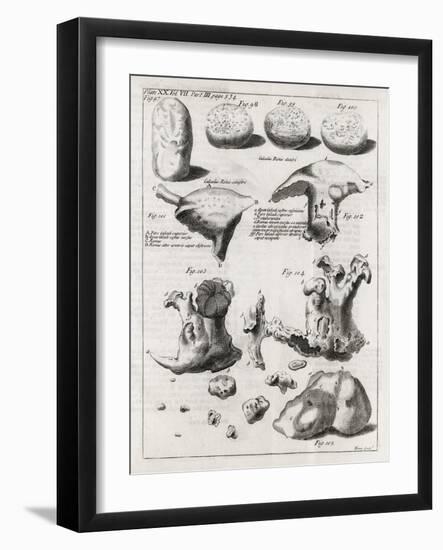 Kidney Stones, 18th Century-Middle Temple Library-Framed Photographic Print