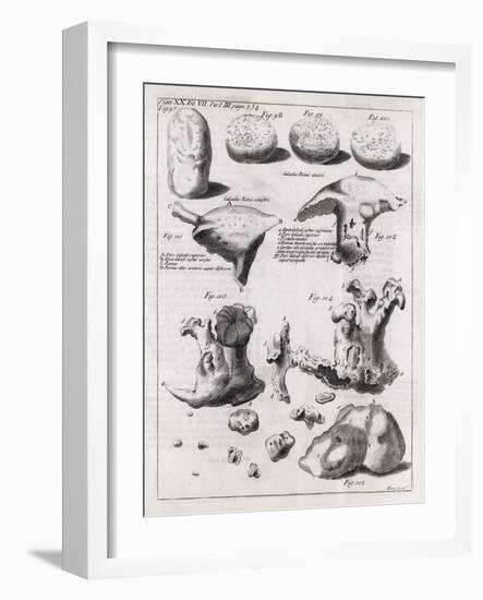 Kidney Stones, 18th Century-Middle Temple Library-Framed Photographic Print