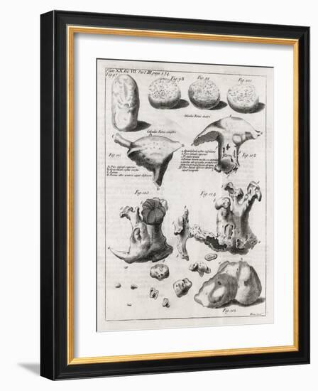 Kidney Stones, 18th Century-Middle Temple Library-Framed Photographic Print