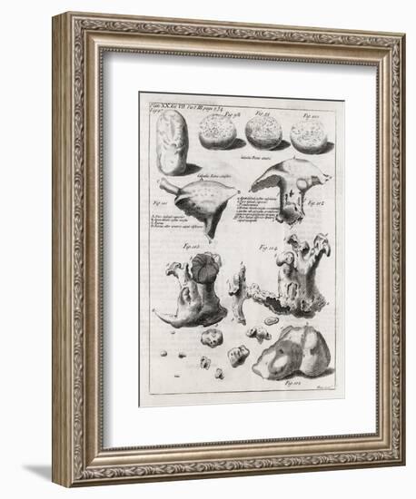 Kidney Stones, 18th Century-Middle Temple Library-Framed Photographic Print