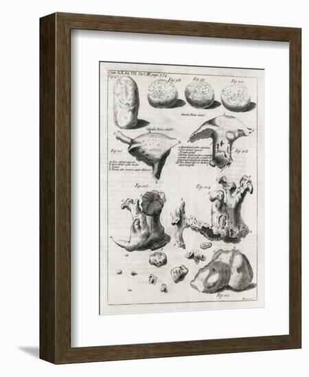 Kidney Stones, 18th Century-Middle Temple Library-Framed Photographic Print