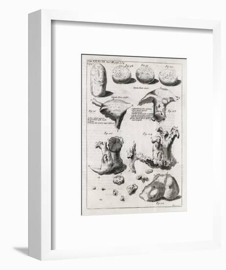 Kidney Stones, 18th Century-Middle Temple Library-Framed Photographic Print