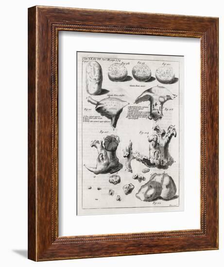 Kidney Stones, 18th Century-Middle Temple Library-Framed Photographic Print