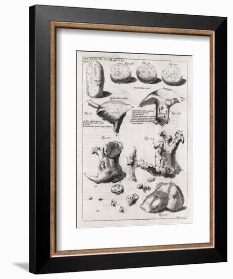 Kidney Stones, 18th Century-Middle Temple Library-Framed Photographic Print