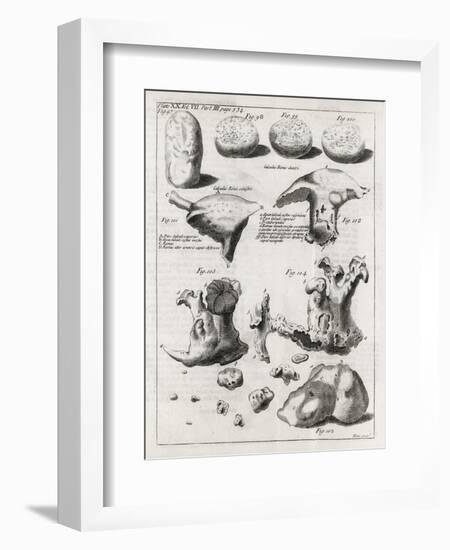 Kidney Stones, 18th Century-Middle Temple Library-Framed Photographic Print