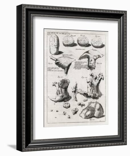Kidney Stones, 18th Century-Middle Temple Library-Framed Photographic Print
