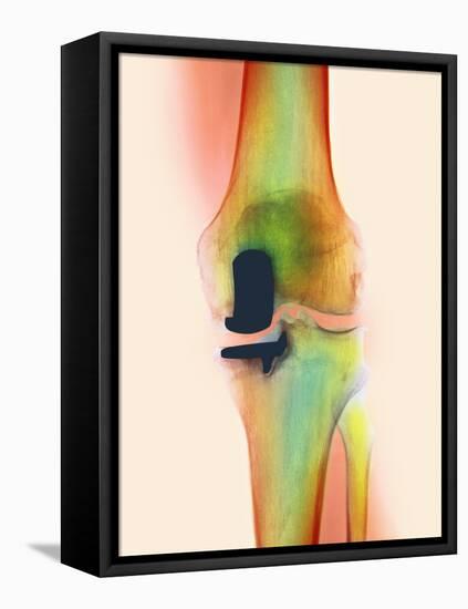 Knee Joint Prosthesis, X-ray-Science Photo Library-Framed Premier Image Canvas