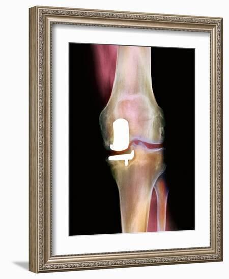 Knee Joint Prosthesis, X-ray-Science Photo Library-Framed Photographic Print