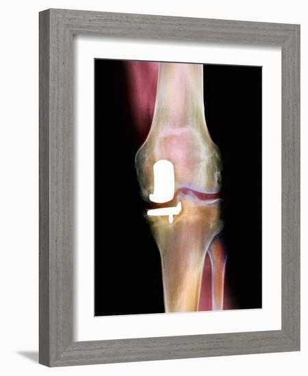 Knee Joint Prosthesis, X-ray-Science Photo Library-Framed Photographic Print