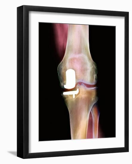 Knee Joint Prosthesis, X-ray-Science Photo Library-Framed Photographic Print