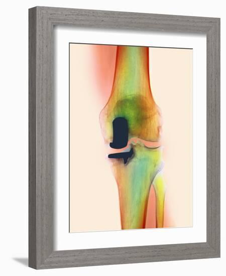 Knee Joint Prosthesis, X-ray-Science Photo Library-Framed Photographic Print