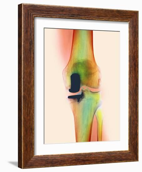 Knee Joint Prosthesis, X-ray-Science Photo Library-Framed Photographic Print