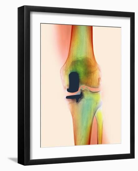 Knee Joint Prosthesis, X-ray-Science Photo Library-Framed Photographic Print