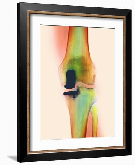 Knee Joint Prosthesis, X-ray-Science Photo Library-Framed Photographic Print