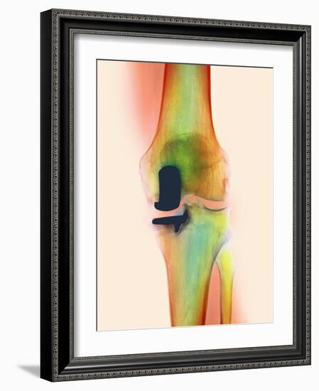 Knee Joint Prosthesis, X-ray-Science Photo Library-Framed Photographic Print