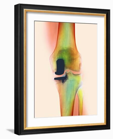 Knee Joint Prosthesis, X-ray-Science Photo Library-Framed Photographic Print