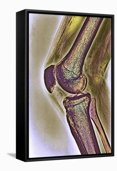 Knee Joint, X-ray-null-Framed Premier Image Canvas