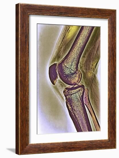 Knee Joint, X-ray-null-Framed Photographic Print