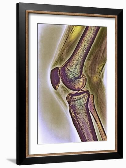 Knee Joint, X-ray-null-Framed Photographic Print