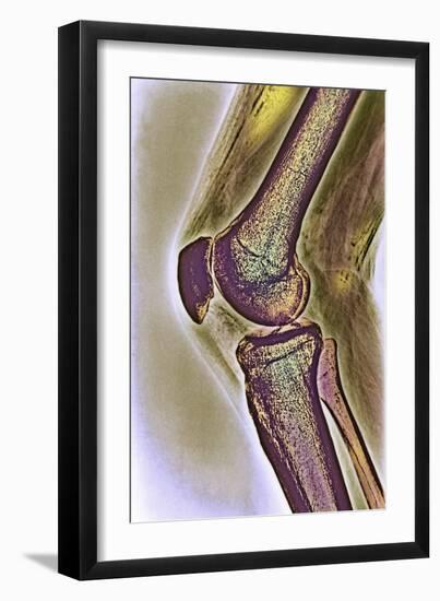 Knee Joint, X-ray-null-Framed Photographic Print
