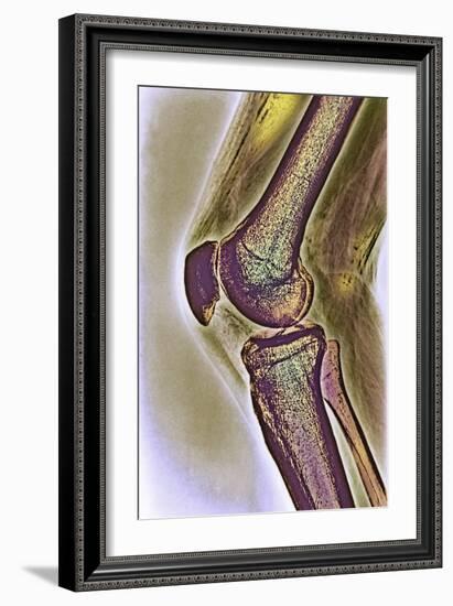 Knee Joint, X-ray-null-Framed Photographic Print
