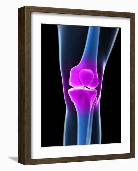 Knee Pain, Conceptual Artwork-SCIEPRO-Framed Photographic Print