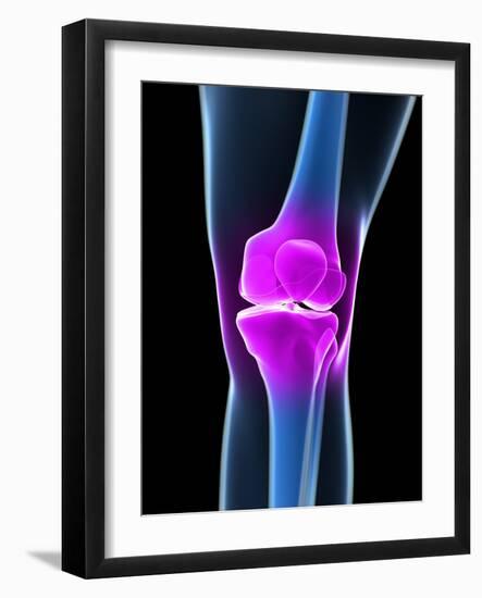 Knee Pain, Conceptual Artwork-SCIEPRO-Framed Photographic Print