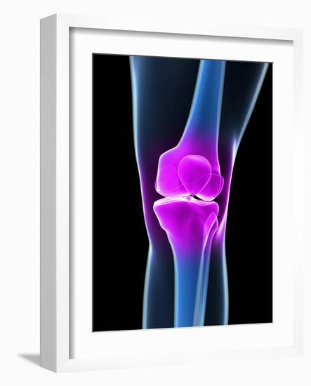 Knee Pain, Conceptual Artwork-SCIEPRO-Framed Photographic Print