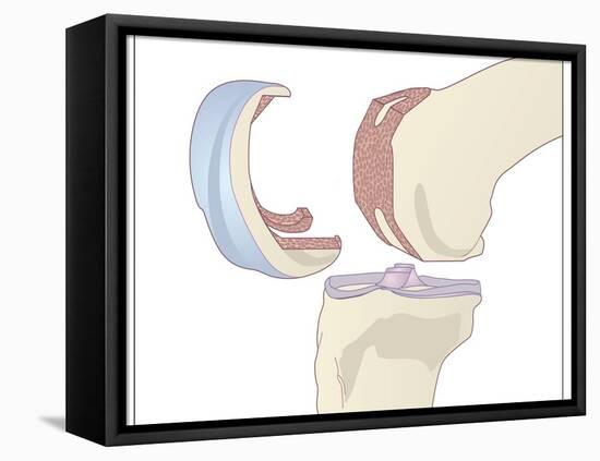 Knee Replacement, Artwork-Peter Gardiner-Framed Premier Image Canvas