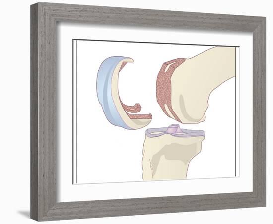 Knee Replacement, Artwork-Peter Gardiner-Framed Photographic Print