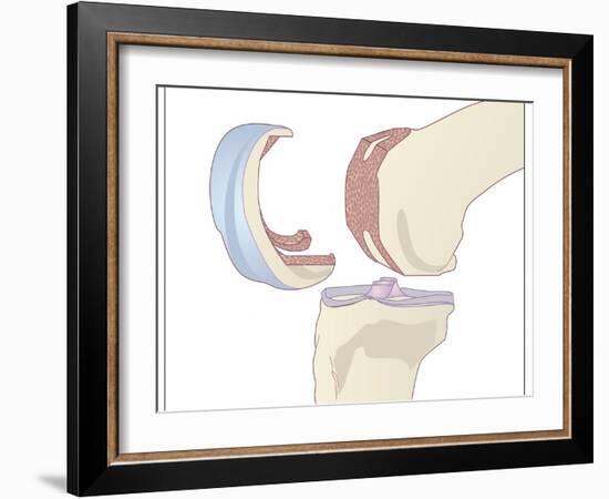 Knee Replacement, Artwork-Peter Gardiner-Framed Photographic Print