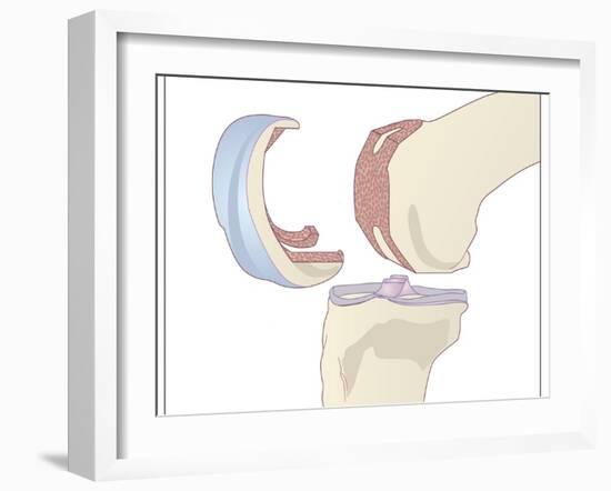 Knee Replacement, Artwork-Peter Gardiner-Framed Photographic Print