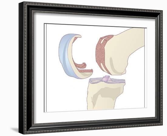 Knee Replacement, Artwork-Peter Gardiner-Framed Photographic Print