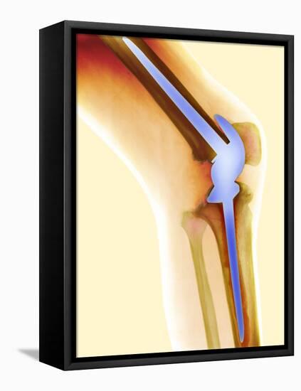 Knee Replacement, X-ray-Science Photo Library-Framed Premier Image Canvas