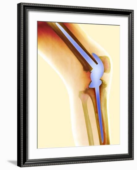 Knee Replacement, X-ray-Science Photo Library-Framed Photographic Print