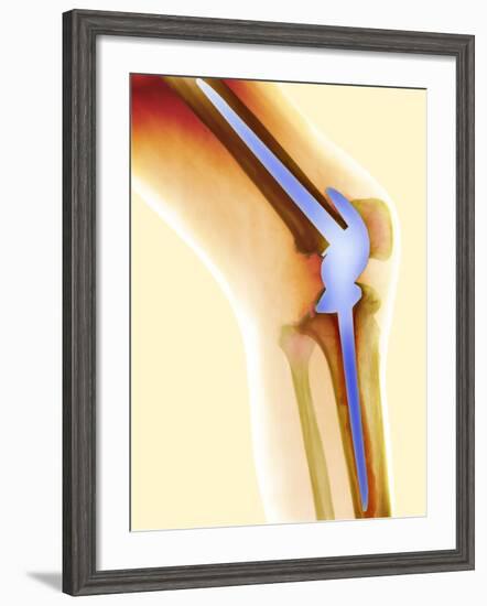 Knee Replacement, X-ray-Science Photo Library-Framed Photographic Print