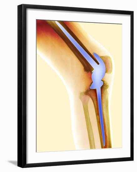 Knee Replacement, X-ray-Science Photo Library-Framed Photographic Print