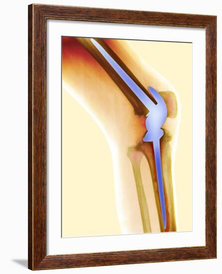 Knee Replacement, X-ray-Science Photo Library-Framed Photographic Print