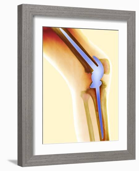 Knee Replacement, X-ray-Science Photo Library-Framed Photographic Print