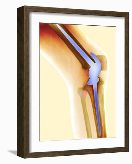 Knee Replacement, X-ray-Science Photo Library-Framed Photographic Print